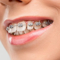 ارتودنسی و مرتب کردن دندان ها